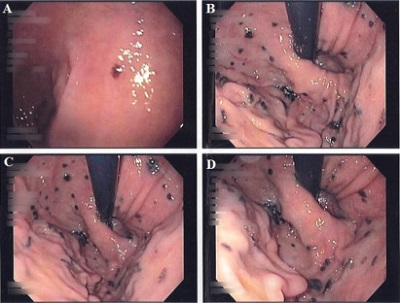 Przerzuty czerniaka w odku; dziwnym trafem zupenie nie chc by biae; https://www.ncbi.nlm.nih.gov/pmc/articles/PMC5016813/