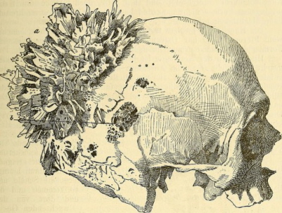 Kostne igieki tworzce kostniakomisaka w tym wypadku mózgoczaszki; E Ziegler, C von Kahlden; “Lehrbuch der allgemeinen pathologischen anatomie und pathogenese” (1887), domena publiczna, https://www.flickr.com/photos/internetarchivebookimages/14577895967/