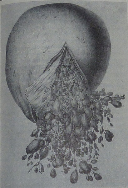 Zawarto macicy – zaniad groniasty, czyli wyjtkowo wty czowiek; Gillain Boivin, XVII/XIX wiek; domena publiczna