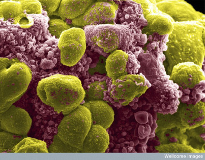 (óte) komórki raka prostaty potraktowane chemioterapeutykiem rozpadaj si na (czerwone) apoptotyczne bbelki; Khuloud T. Al-Jamal & Izzat Suffian, Wellcome Images, CC BY-NC-ND 2.0, https://www.flickr.com/photos/wellcomeimages/15266801865/
