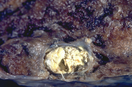 Martwica serowata w pucu, grulica; Yale Rosen, flickr; CC BY-SA 2.0