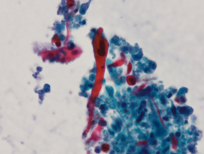 <span>Kijankowata komórka raka paskonabonkowego puc; F D’Aleo, M Maisano i G Albonico; </span>https://www.flickr.com/photos/pulmonary_pathology/6327961626<span>, CC BY-SA 2.0</span>