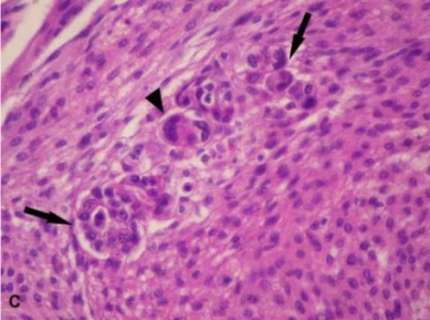 <span>Otoczona strzałkami wysepka przerzutowego raka piersi otoczona morzem komórek oponiaka, nowotworu opon mózgowych; </span>https://www.jscimedcentral.com/Pathology/pathology-3-1049.pdf