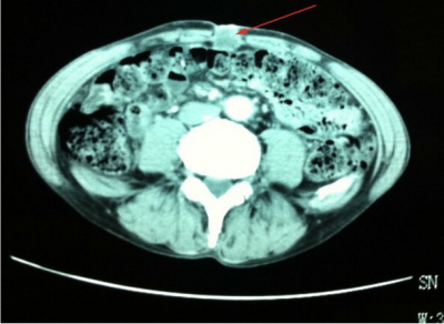 TK jamy brzusznej, strzaka wskazuje guz nowotworowy zlokalizowany w ppku (przerzut raka odbytnicy); CC BY 2.0; http://www.ncbi.nlm.nih.gov/pubmed/24708697