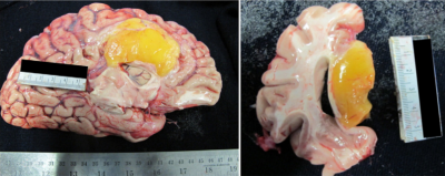 Tuszczak mózgu; CC BY-NC-ND, http://www.humanpathologycasereports.com/article/S2214-3300(16)30017-7/fulltext