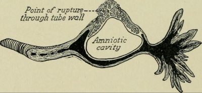 Ci jajowodowa – przekrój; zaznaczone miejsce rozerwania, gdzie naciekajce kosmki tworzcego si oyska znaczco osabiy cian narzdu; Obstetrics for nurses, 1922; https://www.flickr.com/photos/internetarchivebookimages/14766416075/