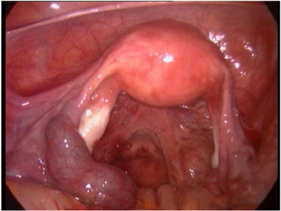 Zaniad potrafi si zagniedzi take w jajowodzie; CC-BY, https://www.ncbi.nlm.nih.gov/pmc/articles/PMC3361201/