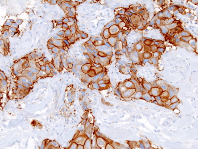 Rak przewodowy sutka wybarwiony przeciwciaem przeciwko HER2; CC BY-SA 3.0, autor nieznany, Wikipedia
