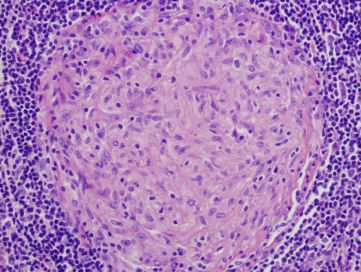 Róowiutka kuleczka ziarniniaka poród ciemnofioletowych kropek limfocytów wza chonnego w przebiegu infekcji Mycobacterium avium; Sanjay Mukhopadhyay, domena publiczna, https://en.wikipedia.org/wiki/Granuloma#/media/File:Granuloma_mac.jpg