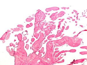Fibroelastoma papillare pod mikroskopem; Nephron; Wikipedia; CC BY-SA 3.0