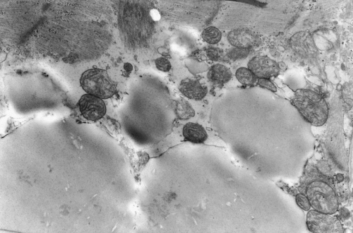 Liczne mitochondria otaczaj wewntrzkomórkowe kropelki tuszczu; G d’Amati et al; © 2010 College of American Pathologists z pozwoleniem na udostpnianie dla celów naukowych i edukacyjnych; http://www.ncbi.nlm.nih.gov/pubmed/10656741