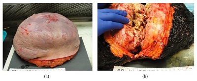 Pilomatrixoma wacy ponad 5,6kg z powyszego zdjcia TK ju po wyciciu; CC-BY, https://www.ncbi.nlm.nih.gov/pmc/articles/PMC4339831/