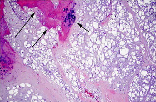 Struniak z zaznaczonym strzałkami resztkowym utkaniem chrząstki i kości; tym razem guz akurat nie wystąpił u czlowieka, a u fretki, jednak jego obraz mikroskopowy jest identyczny. The Joint Pathology Center (JPC) WSCO 04-2013
