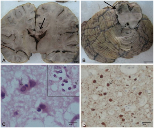 Badanie pośmiertne mózgowia 15-latka z SSPE. A, B: Szarawe, rozmiękłe obszary na przekrojach z lewej – w okolicy spoidła wielkiego, z prawej – śródmózgowia; C: różowe (kwasochłonne) wtręty wirusowe w jądrach komórkowych neuronów i komórek gleju; D: barwienie odpowiednimi przeciwciałami uwidacznia (brązowy kolor) obecność wirusa odry; J Clin Neurol. 2014 Oct; 10(4): 354–357