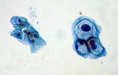 Cytologia ginekologiczna; po lewej zgniecione zdrowe komórki nabłonka płaskiego, po prawej komórki zainfekowane HPV; Ed Uthman; CC BY-SA 2.0