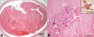 Przekrój przez lew ttnic wiecow przytkan, strzaki wskazuj na kolonie bakteryjne w materiale zatorowym; CC-BY, https://www.ncbi.nlm.nih.gov/pmc/articles/PMC5087979/