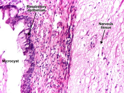 Obraz mikroskopowy potworniaka jajnika – po lewej nabonek oddechowy, po prawej tkanka nerwowa; Dr Mihai Danciu, http://www.pathologyatlas.ro