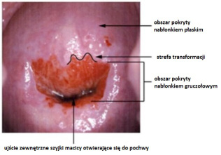 Tarcza czci pochwowej szyjki macicy; http://instituteofwomenshealth.com/wp-content/uploads/2013/01/Sturgis-Anal-Intraepithelial-Neoplasia-Anal-Cancer1.pdf