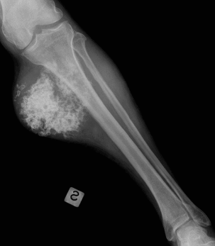 Chrzęstniakomięsak kości podudzia; CC-BY, https://www.ncbi.nlm.nih.gov/pmc/articles/PMC3621361/