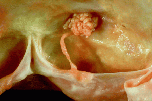 Guzek zastawki aortalnej blokuje odejcie prawej ttnicy wiecowej; @American Heart Association, teaching slide; http://circ.ahajournals.org/content/100/21/2204/F1.expansion.html