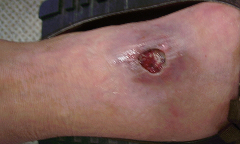“Glonowe” owrzodzenie grzbietu stopy powikane zapaleniem tkanek gbszych; http://www.ncbi.nlm.nih.gov/pmc/articles/PMC2628239/