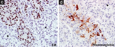 <span>Nowotworowe komórki rozrastajce si poród utkania raka nerki okazay si komórkami raka piersi; te przerzutowego; </span>https://www.ncbi.nlm.nih.gov/pubmed/28937391