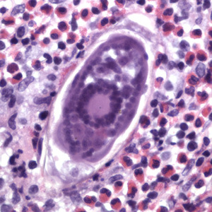 Otoczone naciekiem zapalnym jajko Schistosoma haematobium w cianie pcherza moczowego; domena publiczna; http://www.cdc.gov/dpdx/schistosomiasis/gallery.html#tissue