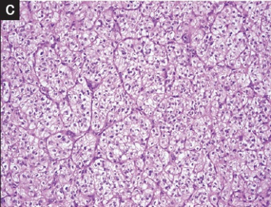 <span>Jasne, jak gdyby puste w rodku (to efekt bogatej w lipidy cytoplazmy) komóreczki raka jasnokomórkowego nerki; </span>https://www.ncbi.nlm.nih.gov/pubmed/28937391