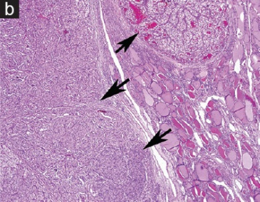 <span>Pola jasnokmórkowych przerzutów raka nerki (strzaki), z prawej i u dou zwyke pcherzyki tarczycowe; </span>https://www.ncbi.nlm.nih.gov/pubmed/28937391