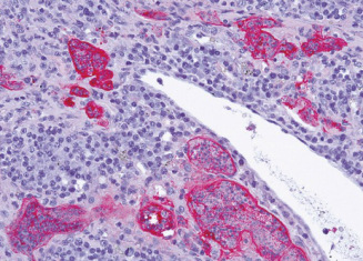 Naciek w wle chonnym wybarwiony na czerwono koktajlem przeciwcia przeciwko biakom tasiemczym; http://www.nejm.org/doi/full/10.1056/NEJMoa1505892#t=article