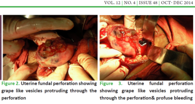 Bbelki widoczne w dnie rozerwanej macicy; Sinha et al, http://tinyurl.com/hv2ax7o