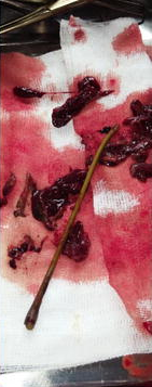 odyga manioku i skrzepy krwi usunite z dróg rodnych kobiety próbujcej samodzielnie dokona aborcji; http://www.ncbi.nlm.nih.gov/pmc/articles/PMC4754930/