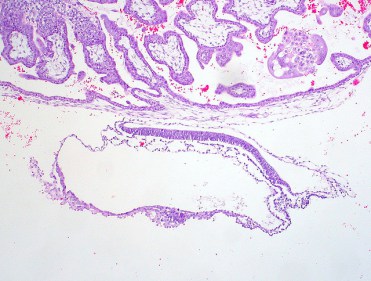 Zarodek w 4-5 tygodniu ciy widziany pod mikroskopem, ok. 1mm (zarodek to ten owalny, nieco wikszy bbelek na dole; górna poowa obejmuje wczesne kosmki tworzce oysko); Ed Uthman, MD; CC BY 2.0