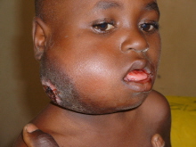 Siedmioletni Nigeryjczyk z owrzodziaym choniakiem Burkitta; Mike Blyth; CC BY-SA 2.5