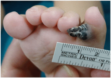 Pokryty strupem czarnobrunatny guzek na palcu niemowlcia; http://adc.bmj.com/content/100/7/630