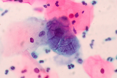 Komórka zainfekowana HSV w cytologii ginekologicznej; Ed Uthman; CC BY-SA 2.0