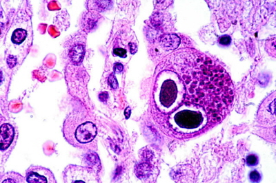 Obraz “sowich oczu”, komórka zakażona CMV; http://www.pathologyoutlines.com/topic/skinnontumorcmv.html