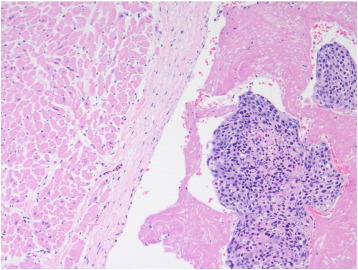 Po prawej czciowo martwicze (bezpostaciowe róowe masy) tkanki guza, po lewej ciana serca; CC BY-NC-ND 4.0, http://www.sciencedirect.com/science/article/pii/S2214330016300840