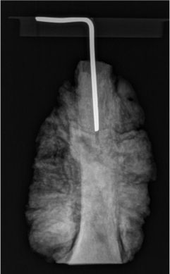 Obraz radiologiczny zachowanej w zbiorach muzealnych amputowanej koczyny historycznego pacjenta; http://www.bmj.com/content/355/bmj.i6515