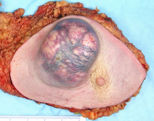 Rak piersi bywa niekiedy do drastyczny; Wikimedia, Emmanuelm; CC BY 3.0