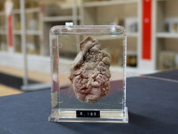 Rak moszny, preparat z 1846 roku; Hayley Campbell/BuzzFeed, Barts Pathology museum; https://www.buzzfeed.com/hayleycampbell/printing-machines-are-for-printing-not-this?utm_term=.yuvwEQJKy#.cbQXzGnde