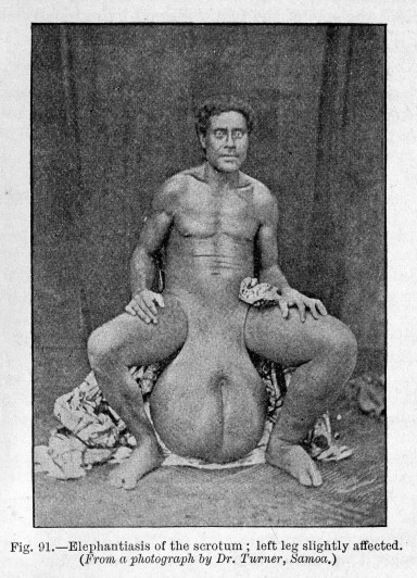 Obrzk limfatyczny moszny w przebiegu filariozy; Wellcome Library, 1909, CC BY 4.0 https://de.wikipedia.org/wiki/Elephantiasis