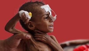 Niedożywione dziecko w jemeńskim szpitalu