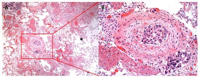 <span>Przytykajce drobn ttnic (i obok zapewne y) komórki raka gruczoowego puc; CC-BY-NC 4.0, </span>http://www.journalmc.org/index.php/JMC/article/view/263/244