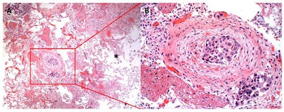 <span>Przytykające drobną tętnicę (i obok zapewne żyłę) komórki raka gruczołowego płuc; CC-BY-NC 4.0, </span>http://www.journalmc.org/index.php/JMC/article/view/263/244