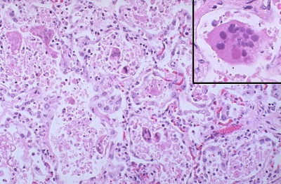 Zapalenie płuc wywołane przez RSV; w rogu komórka olbrzymia wielojądrzasta z inkluzją cytoplazmatyczną; http://library.med.utah.edu/WebPath/LUNGHTML/LUNG158.html