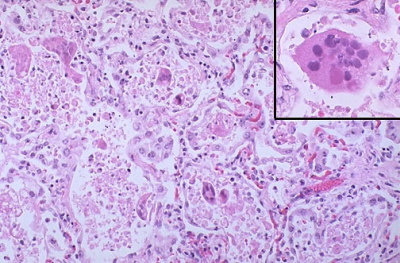 Zapalenie puc wywoane przez RSV; w rogu komórka olbrzymia wielojdrzasta z inkluzj cytoplazmatyczn; http://library.med.utah.edu/WebPath/LUNGHTML/LUNG158.html