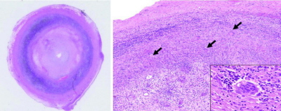 Ttnica ramienna o pogrubiaej cianie i bardzo zwonym wietle, po prawej widoczny naciek zapalny i komórki olbrzymie w cianie naczynia; http://www.ncbi.nlm.nih.gov/pmc/articles/PMC3595803/