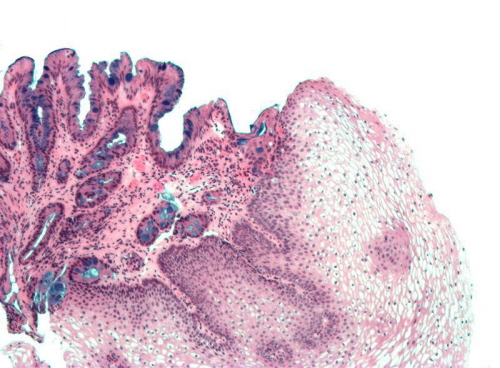 Jeden z klasycznych przykładów metaplazji – miejsce prawidłowego nabłonka płaskiego przełyku (prawa strona zdjęcia) zajmuje nabłonek gruczołowy typu jelitowego (po lewej); na niebiesko dodatkowe barwienie histochemiczne wybarwia komórki zawierające śluz; Nephron; Wikipedia; CC BY-SA 3.0