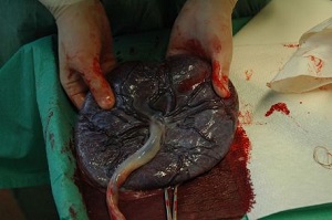 Krwisty pokryty bonami podowymi pulpet; Inferis, CC BY-SA 2.0, https://commons.wikimedia.org/wiki/Placenta#/media/File:Placenta_held.jpg